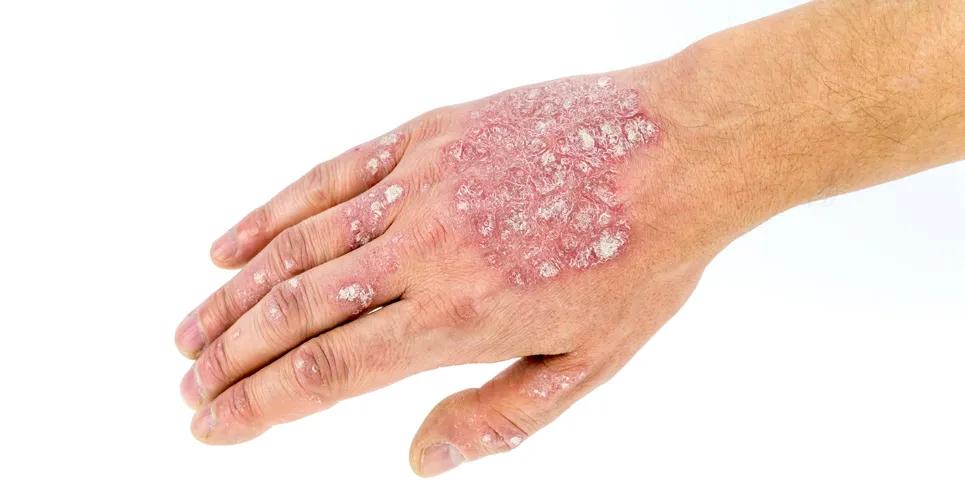 How Is Eczema Treatment Evaluated?