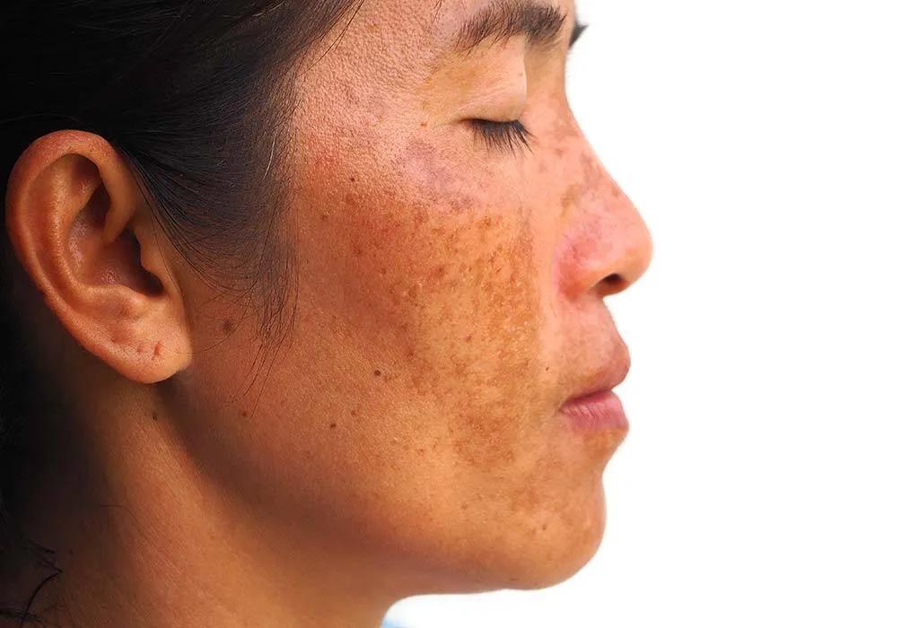 Is The Best Pigmentation Treatment Different For Face?
