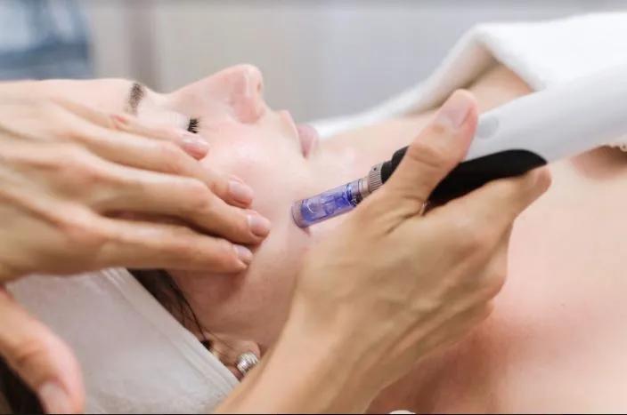 Is Microneedling for Acne Scars a Valid Treatment?