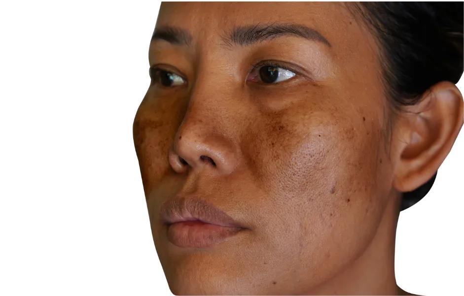 How Do Experts Define Best Pigmentation Treatment?